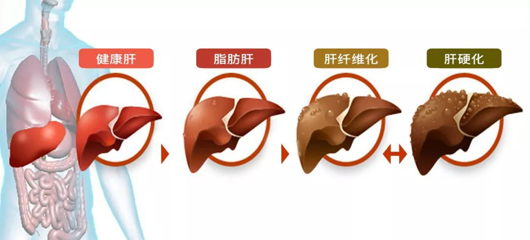 肝纤维化  流程图.jpg