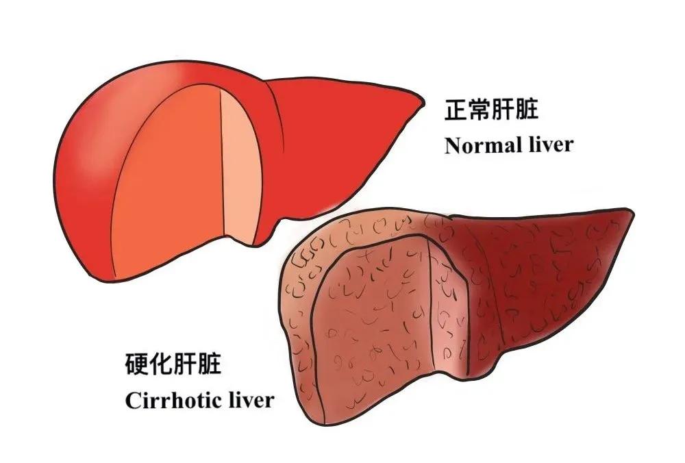 肝纤维化  迈源生物.jpg